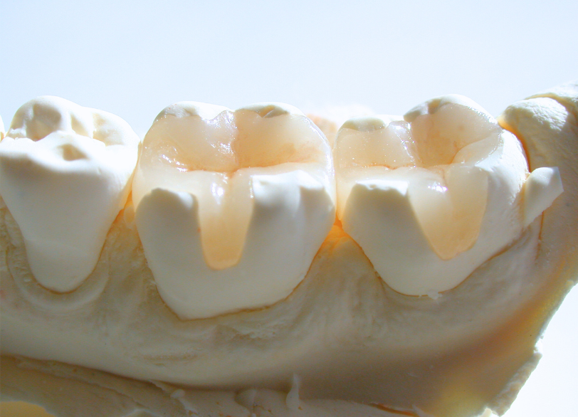 セラミック｜古屋歯科