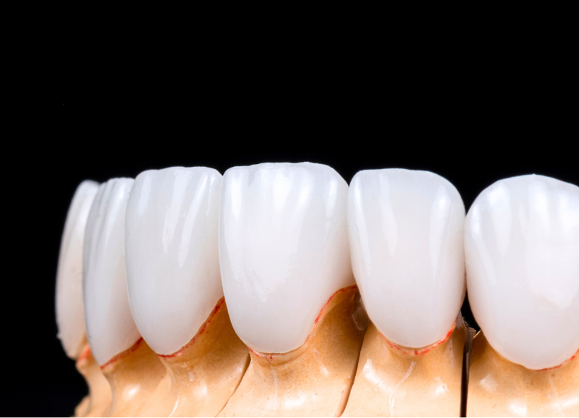 e-max｜古屋歯科