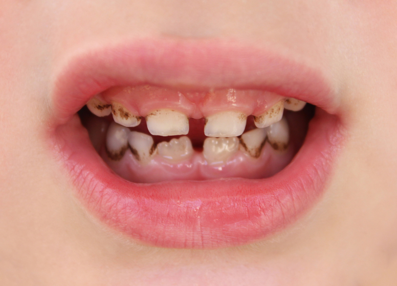 虫歯治療｜古屋歯科