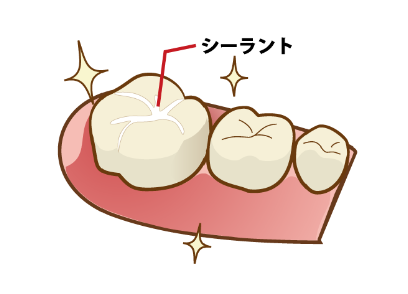 シーラント｜古屋歯科