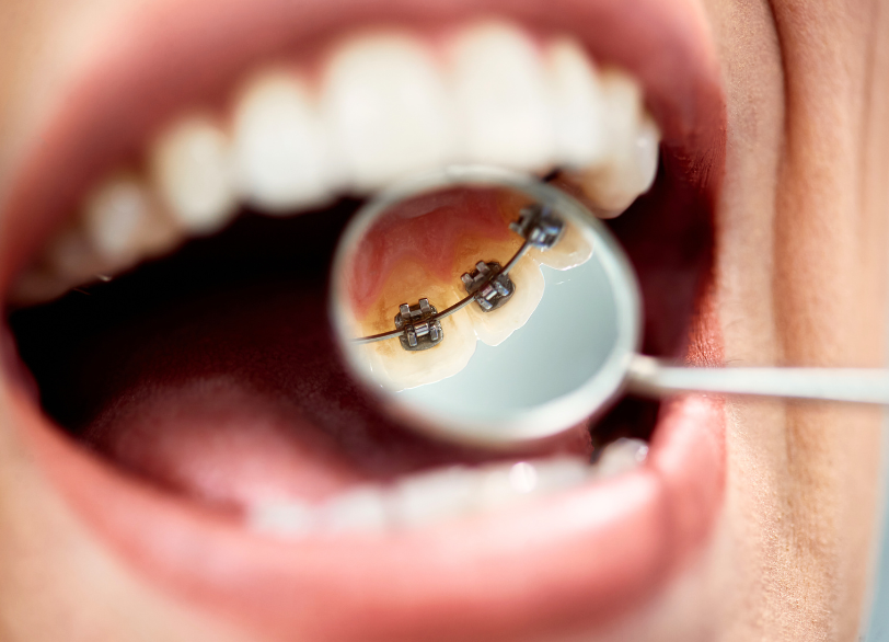 リンガルブラケット｜古屋歯科