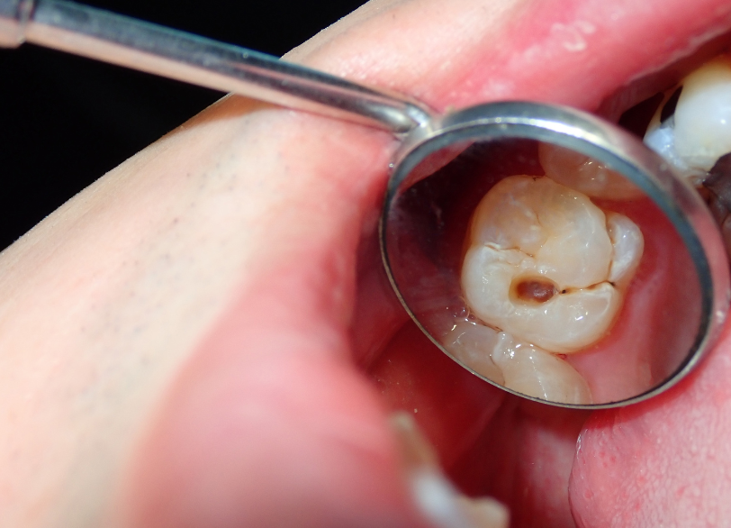 虫歯治療|古屋歯科