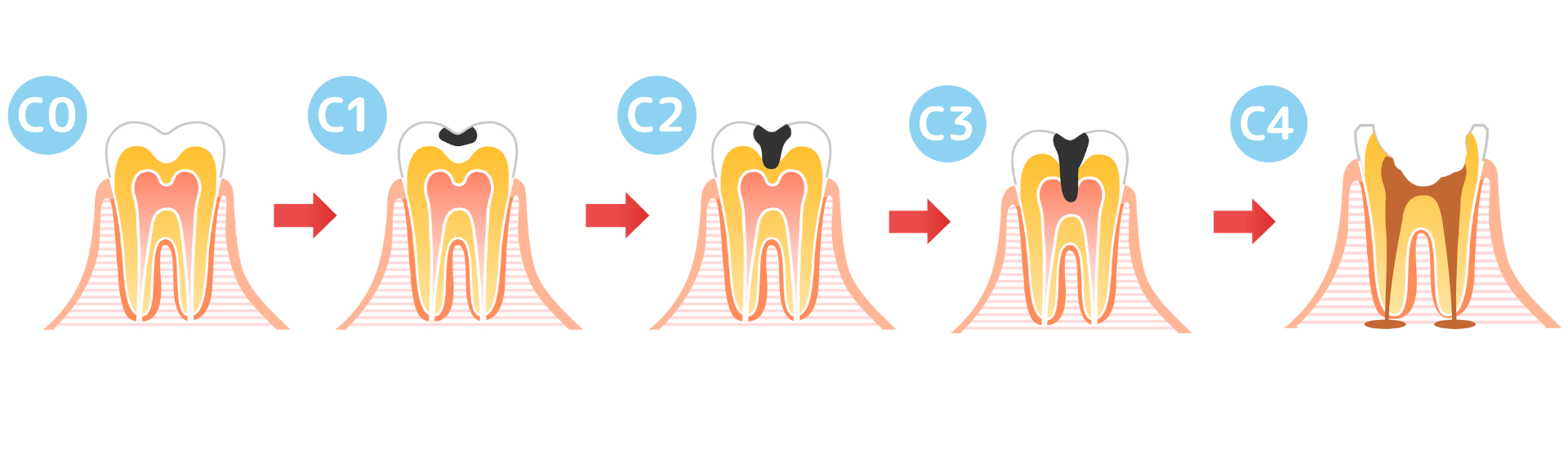 虫歯の進行|古屋歯科