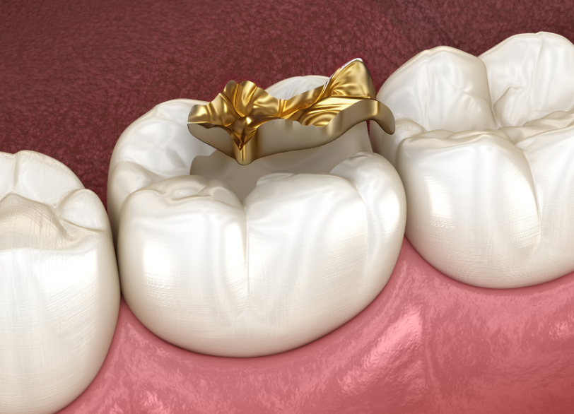 ゴールド|古屋歯科