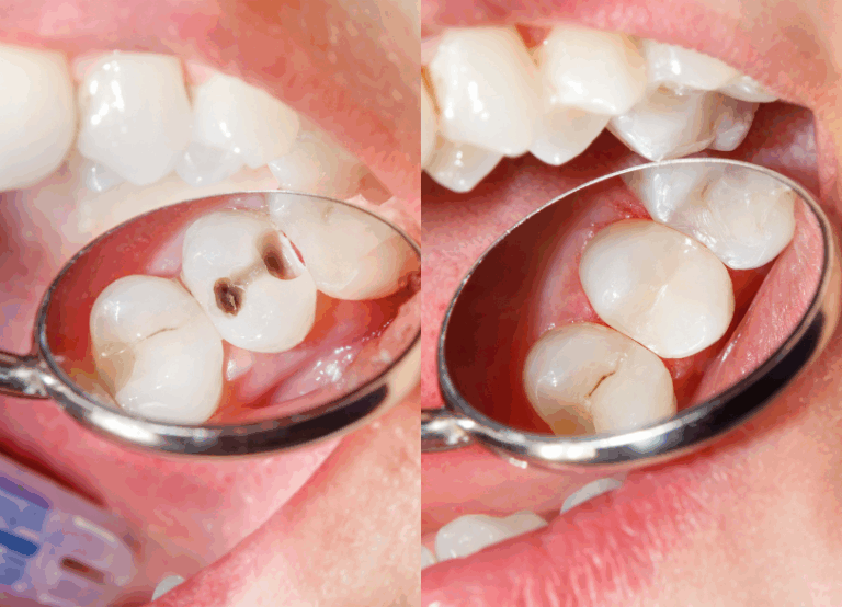 コンポジットレジン|古屋歯科