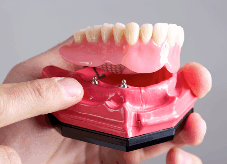 マグネットデンチャー｜古屋歯科