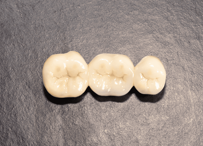 ブリッジ｜古屋歯科