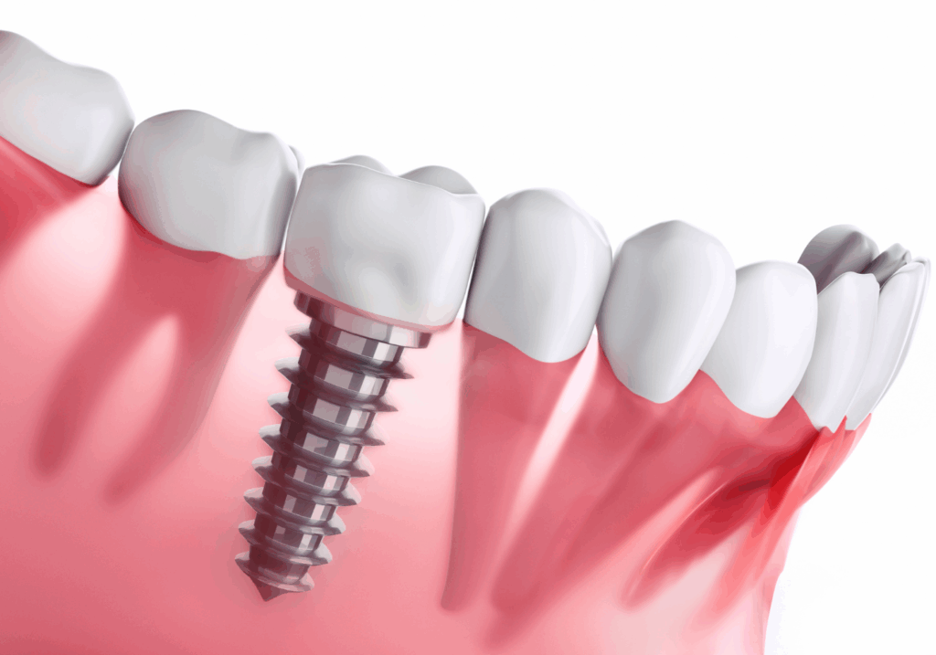 インプラント｜古屋歯科