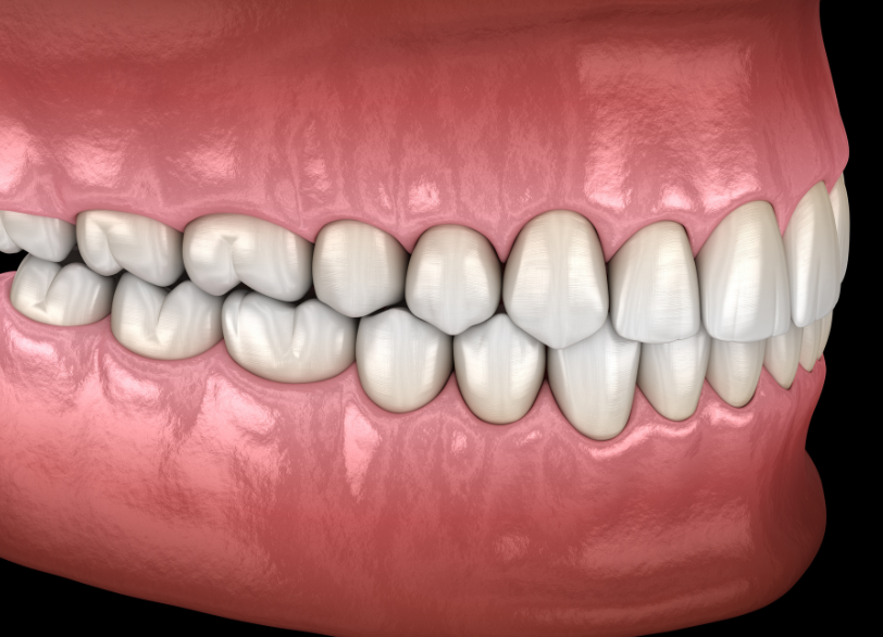 良い噛み合わせ｜古屋歯科