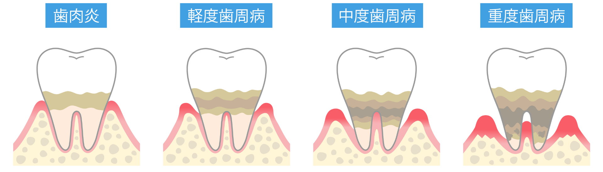 歯周病の進行｜古屋歯科
