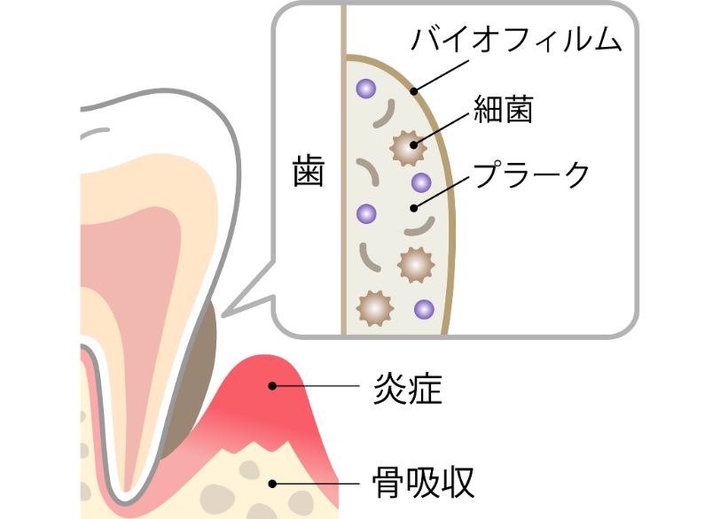 歯垢（プラーク）｜古屋歯科