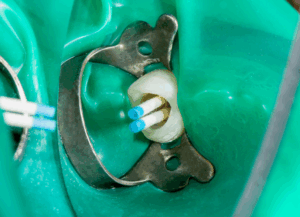 緊密な充填|古屋歯科