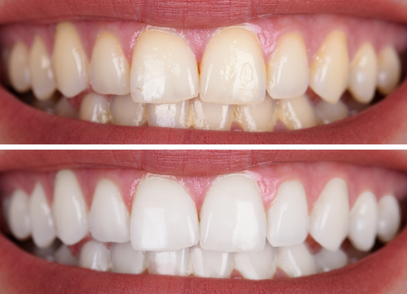 デュアルホワイトニング｜古屋歯科