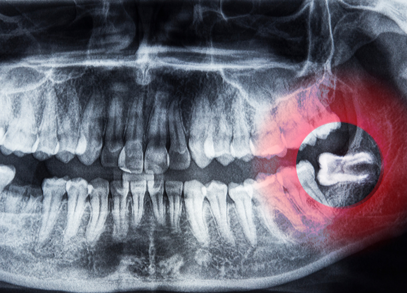 親知らずとは｜古屋歯科