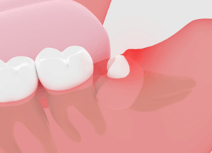 智歯周囲炎｜古屋歯科