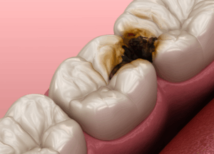 虫歯｜古屋歯科