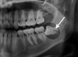 のう胞の形成｜古屋歯科